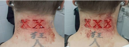 a389_scarification