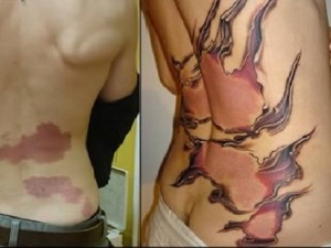 a98541_tattoo-scars_5-birthmarks